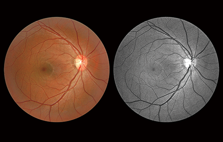 tomogafia Ottica Computerizzata OTC Rozzano Delta Medica