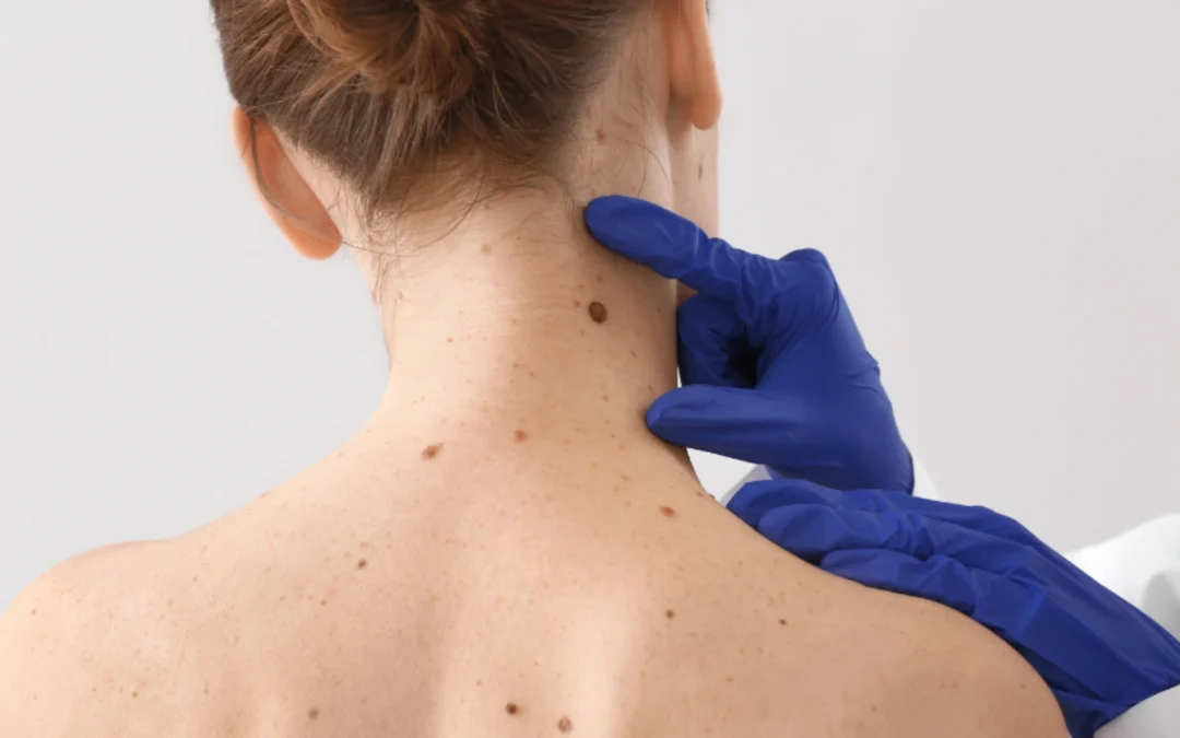 Prevenzione del melanoma