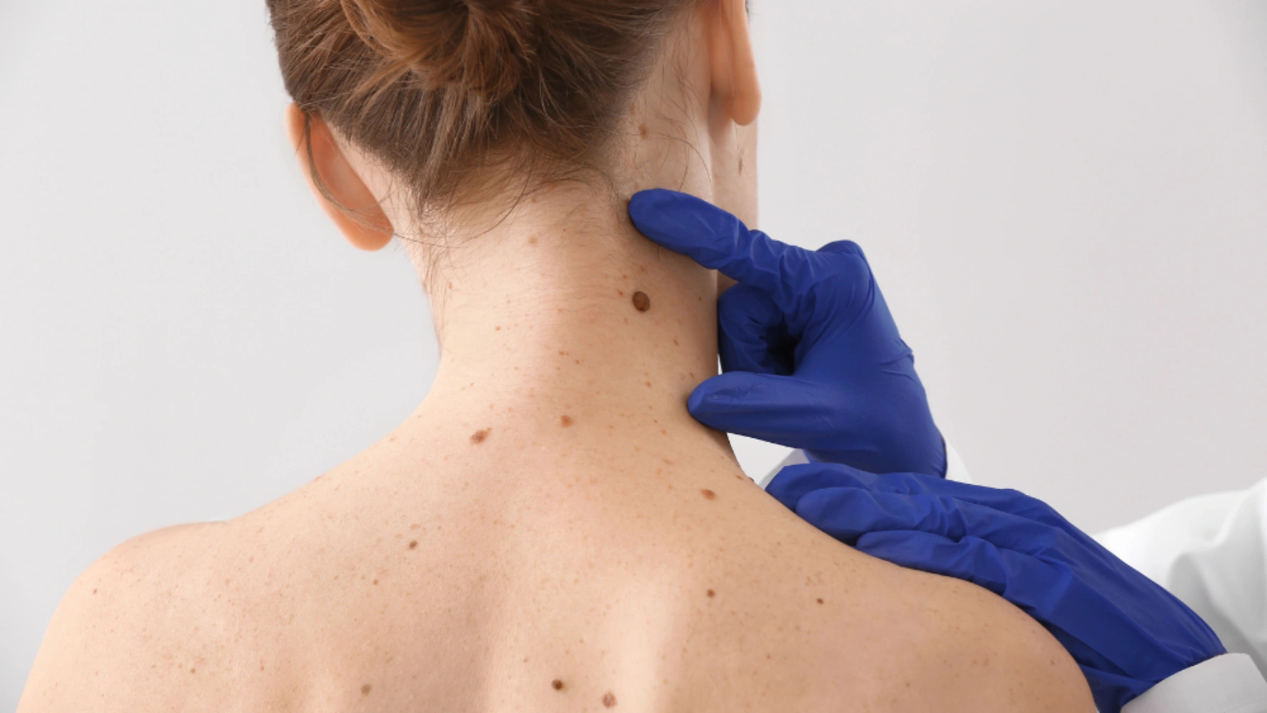 Prevenzione del melanoma