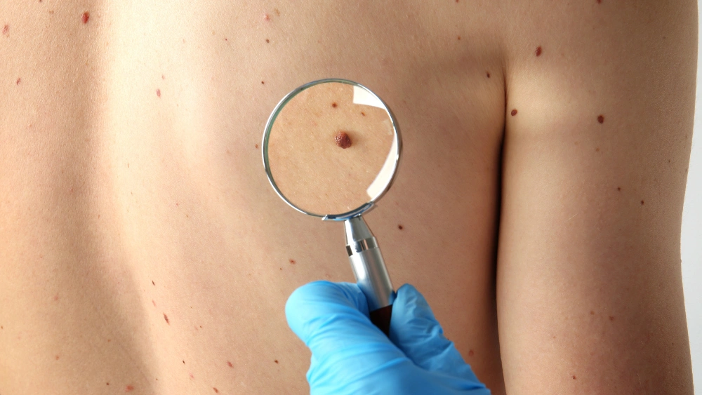 Cos’è il melanoma? Come si può riconoscere? 