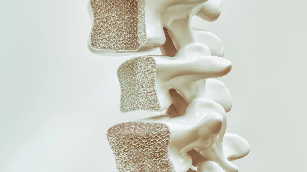 Rendering 3d dell'osteoporosi sulla colonna vertebrale - perché è importante misurare la densità ossea con la MOC